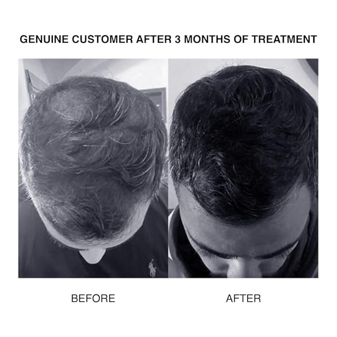 PATRICKS | CD Plus Ultra Thickening Conditioner | DHT Blocker | Includes Zinc & Powerful Ingredients to Support Hair Growth & Care | For Moderate to Advanced Hair Loss | 200mL