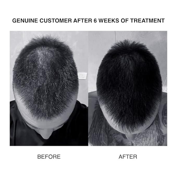 PATRICKS | CD Plus Ultra Thickening Conditioner | DHT Blocker | Includes Zinc & Powerful Ingredients to Support Hair Growth & Care | For Moderate to Advanced Hair Loss | 200mL