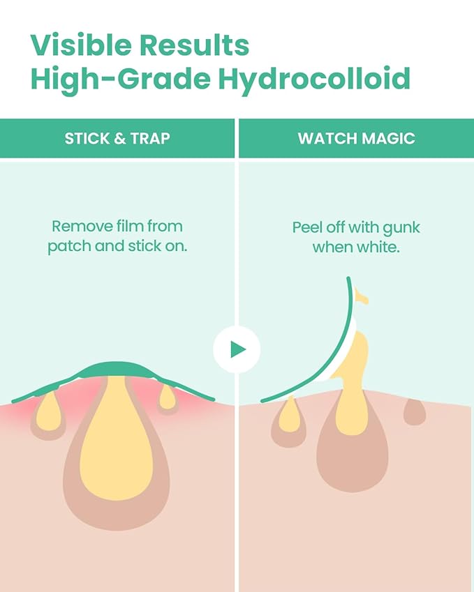 GLAM UP Spotless Nose Patch Hydrocolloid Coverage for Nose Pores, Zits and Oil - Overnight Strong Waterproof to Absorb Blackheads & Pimple Nose Gunk, and Calm with Tea Tree (12 Patches)