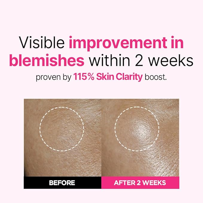 ISOI Rosy Glow Duo - Blemish Care Up Serum & Eye Wrinkle Patch for Glass Skin, Korean Skincare