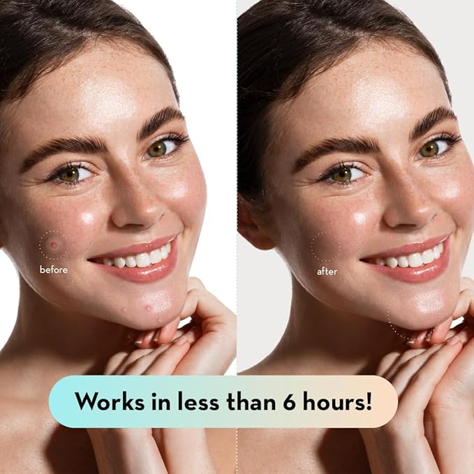 LE GUSHE Korean Pimple Patches for Face (78 Dots) - Hydrocolloid Acne Patches with Tea Tree Oil - Invisible Zit Stickers - Dermatologist Tested - Korean Skin Care