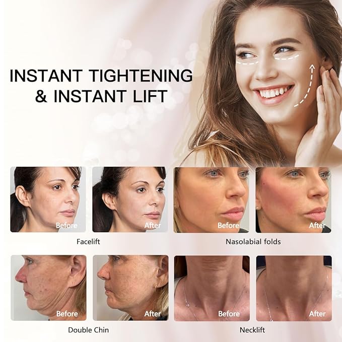 PDO Thread(Mono screw 30G 38MM) Lift/Face Body Lifting/Smooth Mono Type 38mm (50pieces)