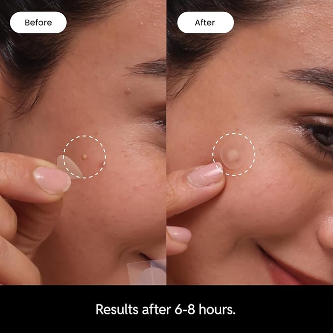 Eliré Night Time Pimple Patch – Extra Strength Hydrocolloid Stickers for Overnight Pimple Healing – Absorbs Pus & Protects Skin – Dermatologist-Tested & Non-Drying