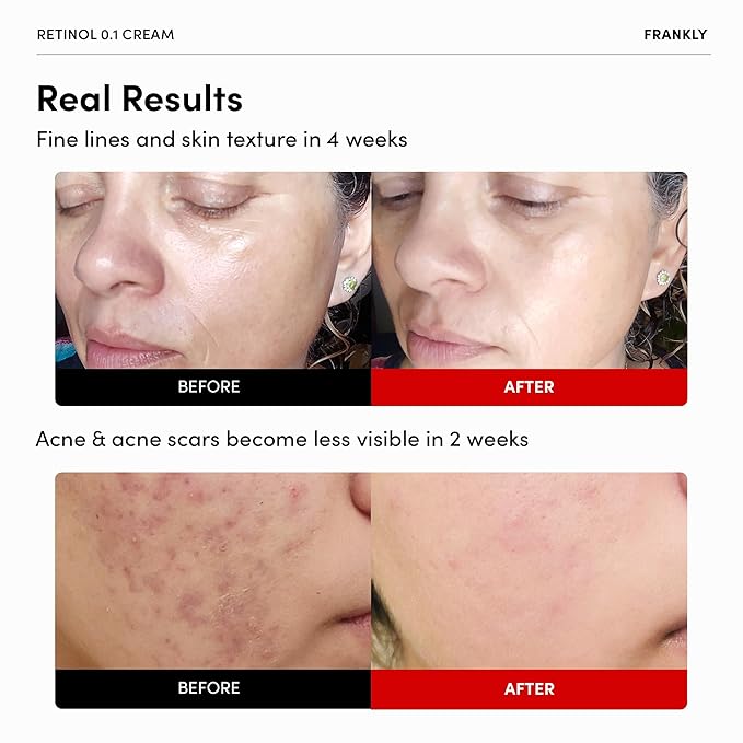 FRANKLY Retinol 0.3% Cream, 0.7 fl oz - Intensive Retinol | Night Cream | Retinol, Ceramides & Natural Ginseng | Anti-aging, Wrinkles Care, Reduces Congestion and hyperpigmentation | Korean Skin Care