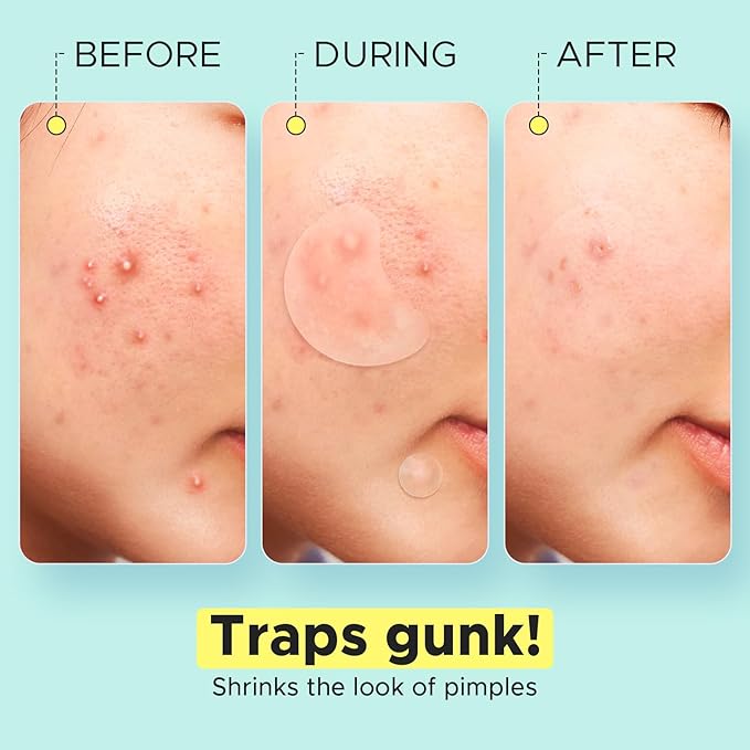 LitBear Pimple Patch Bulk (720 Patches 3 Size) Pimple Patches for Face (5 Sizes, 507Patches)