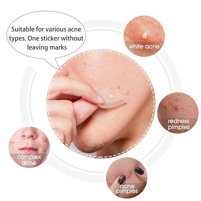Hydrocolloid Acne Patch(20 Patches), Large Spot Control Cover With Long Size, Extra Larger Acne Pimple Patch for Covering Large Breakouts, Spot Patch, Stickers for Body, Cheek, Forehead, and Chin
