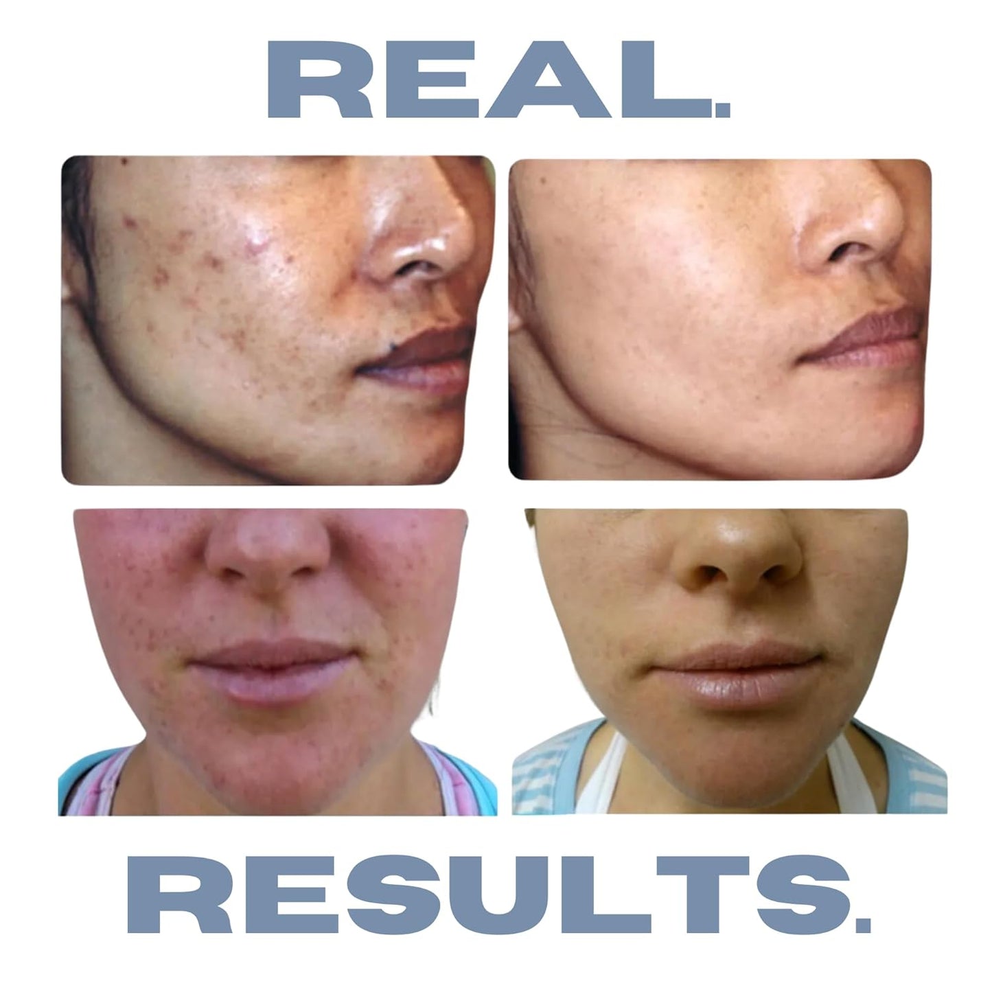 Acne Treatment Kit, Acne Kit, Skin Care Acne, Acne Skin Care Set, Natural Anti-DHT Deluxe Set Original Formula Benzoyl Peroxide 3-Piece Set, 1-Month Supply