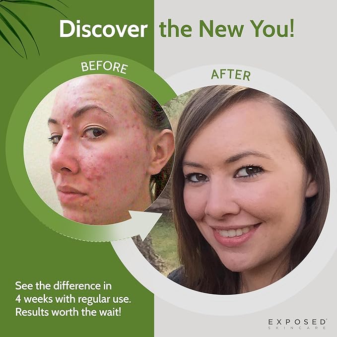 Exposed Skin Care Acne Treatment Kit - Includes Facial Cleanser, Clearing Tonic, Acne Treatment Serum, Clear Pore Serum, Clarifying Mask, Cloth - Natural Acne Solution for Face, All Ages & Skin Types