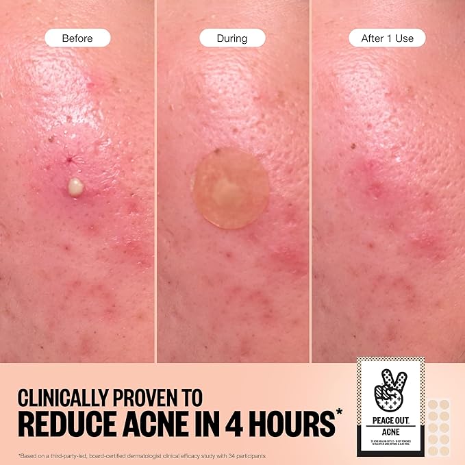 PEACE OUT Acne Healing Dots Helps Clear Blemishes Overnight, Fast Acting Hydrocolloid Pimple Patches for Breakouts with Salicylic Acid, Retinol and Aloe Vera, Award Winning Skincare Solution 40 Count
