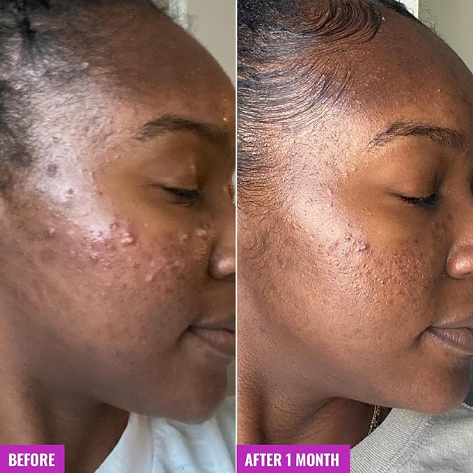 Good Molecules Acne Foaming Cleanser - 2% Salicylic Acid Foam Cleanser - Gentle Acne Face Wash with Alcohol Free Witch Hazel and Aloe - Skin Care for Face