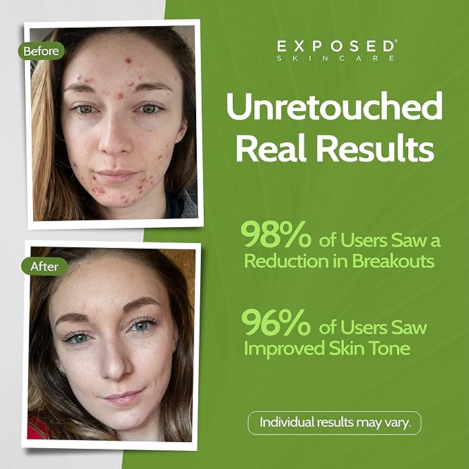 Exposed Skin Care, Acne Facial Cleanser with 0.5% Salicylic Acid for Sensitive and Acne-Prone Skin – Gentle Daily Face Wash for Breakout, Blackhead and Excess Oil – Natural, Non-toxic and Cruelty Free